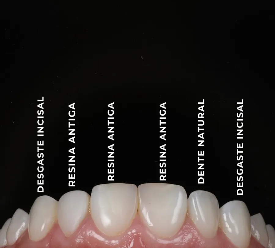 Mapa do caso: desgaste incisal, resina antiga, dente natural