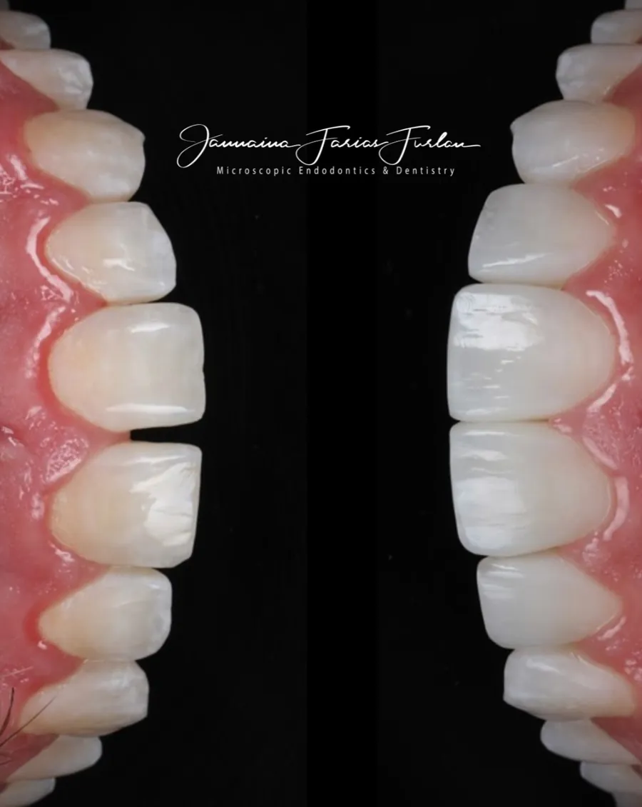 Dentes em resina vistos de perfil, fundo preto
